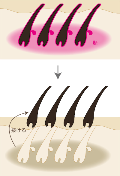 脱毛のメカニズム１